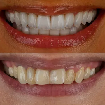 نمونه کار لمینت